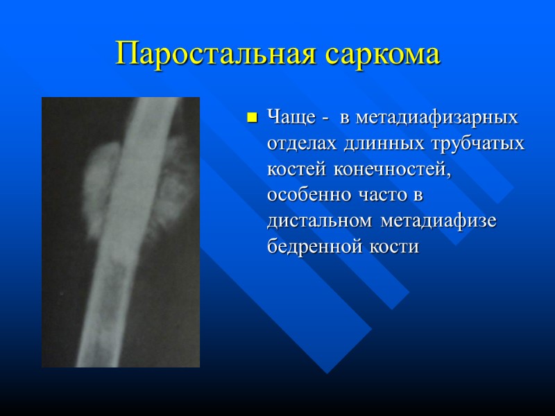 Паростальная саркома Чаще -  в метадиафизарных отделах длинных трубчатых костей конечностей, особенно часто